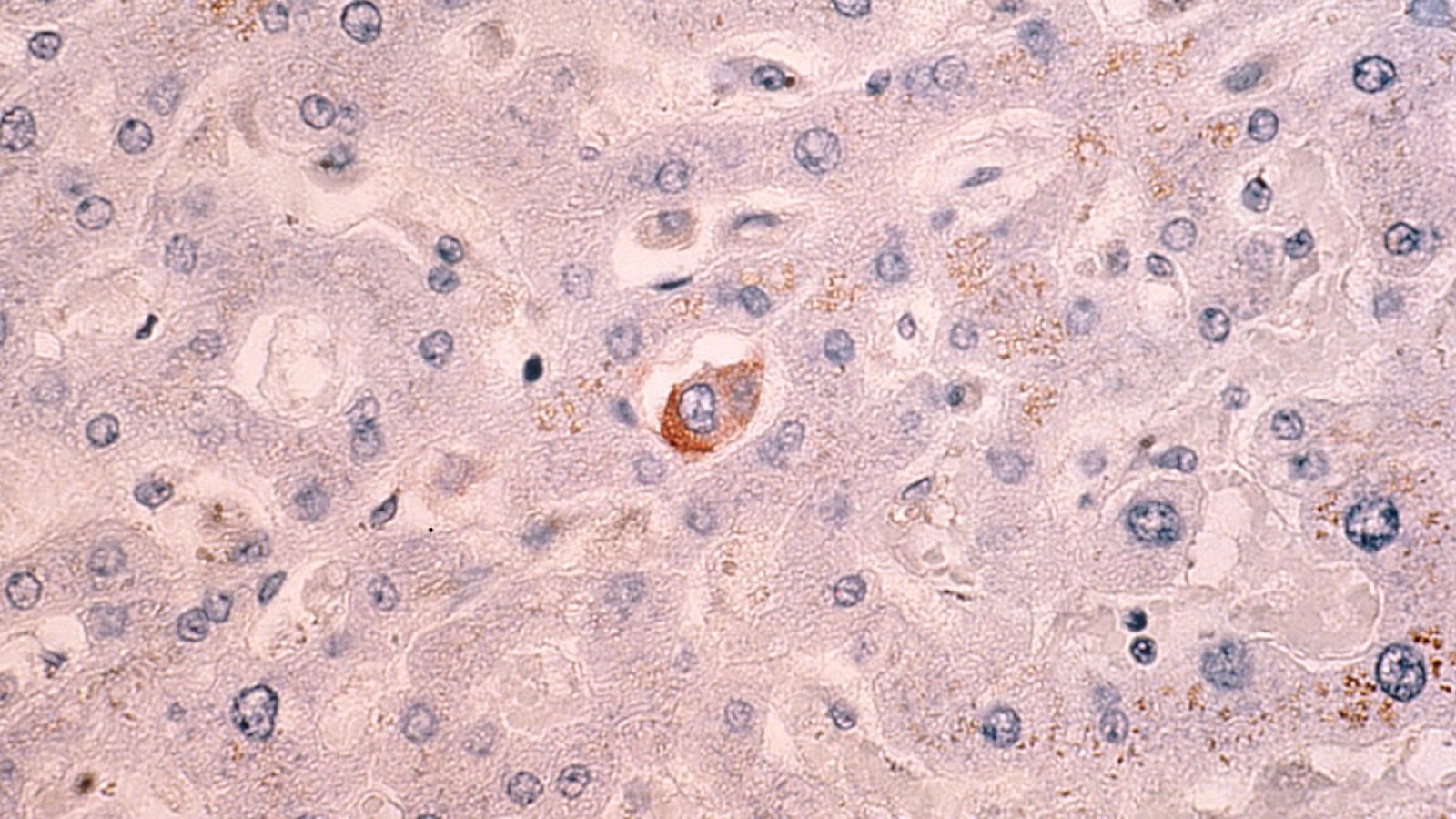 Cèl·lula maligna de càncer de mama circulant dins dels sinusoides hepàtics