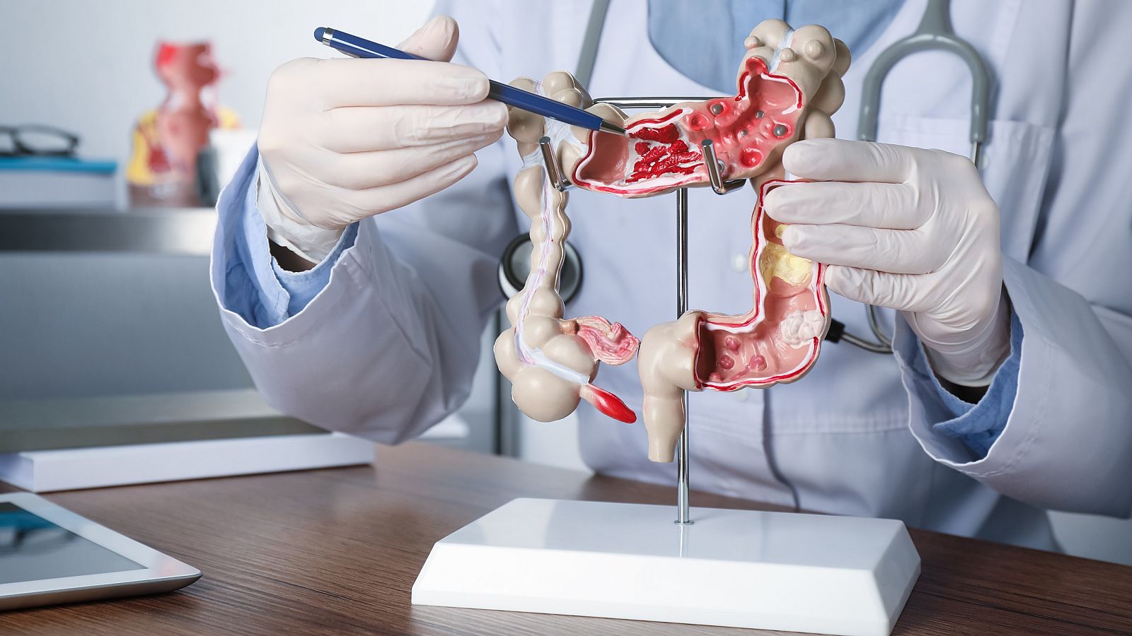 El cáncer de colon es el tercer tumor maligno más frecuente del planeta.