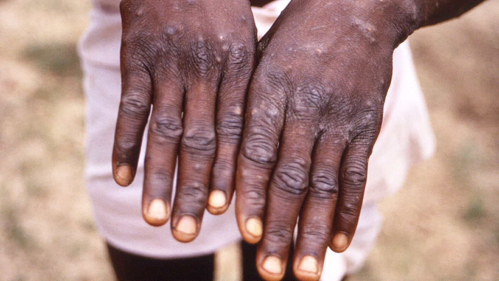 La viruela del mono genera una erupción que suele comenzar en la cara y después se extiende por el cuerpo.