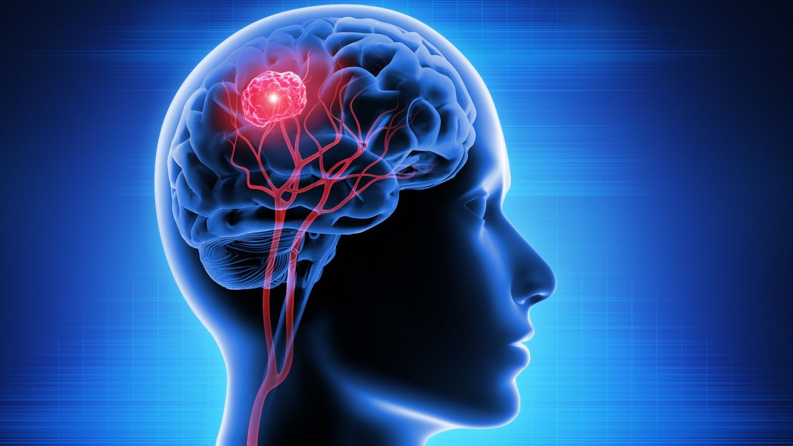 Representación de una persona con un tumor cerebral