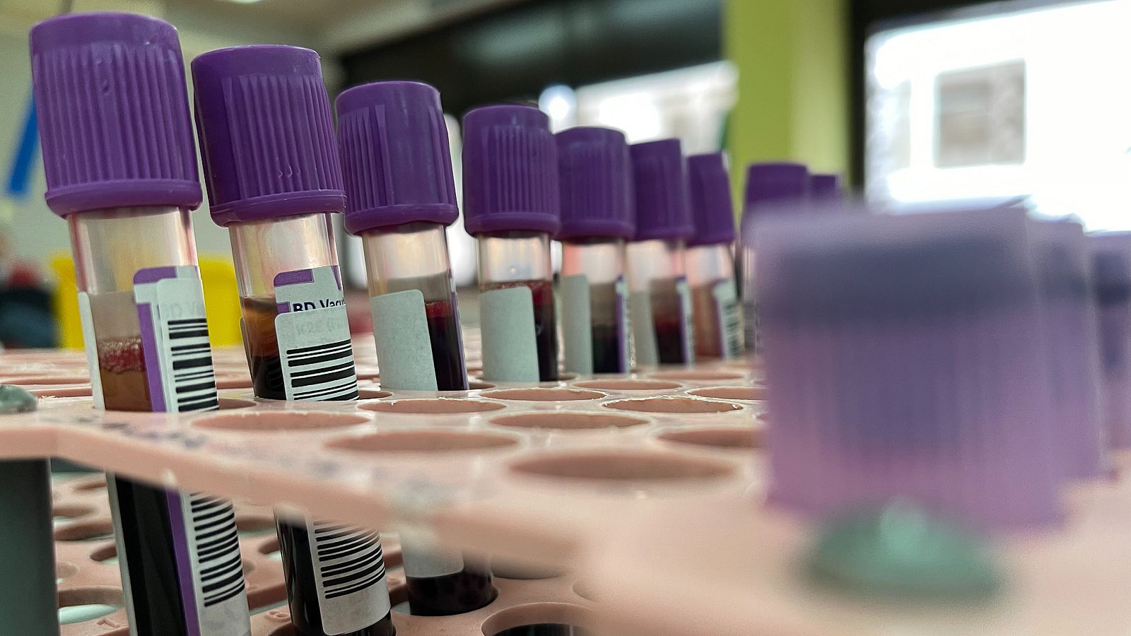 La investigación ha analizado los casos de 382 personas con VIH avanzado, de las que 107 fueron hospitalizadas y 27 murieron.