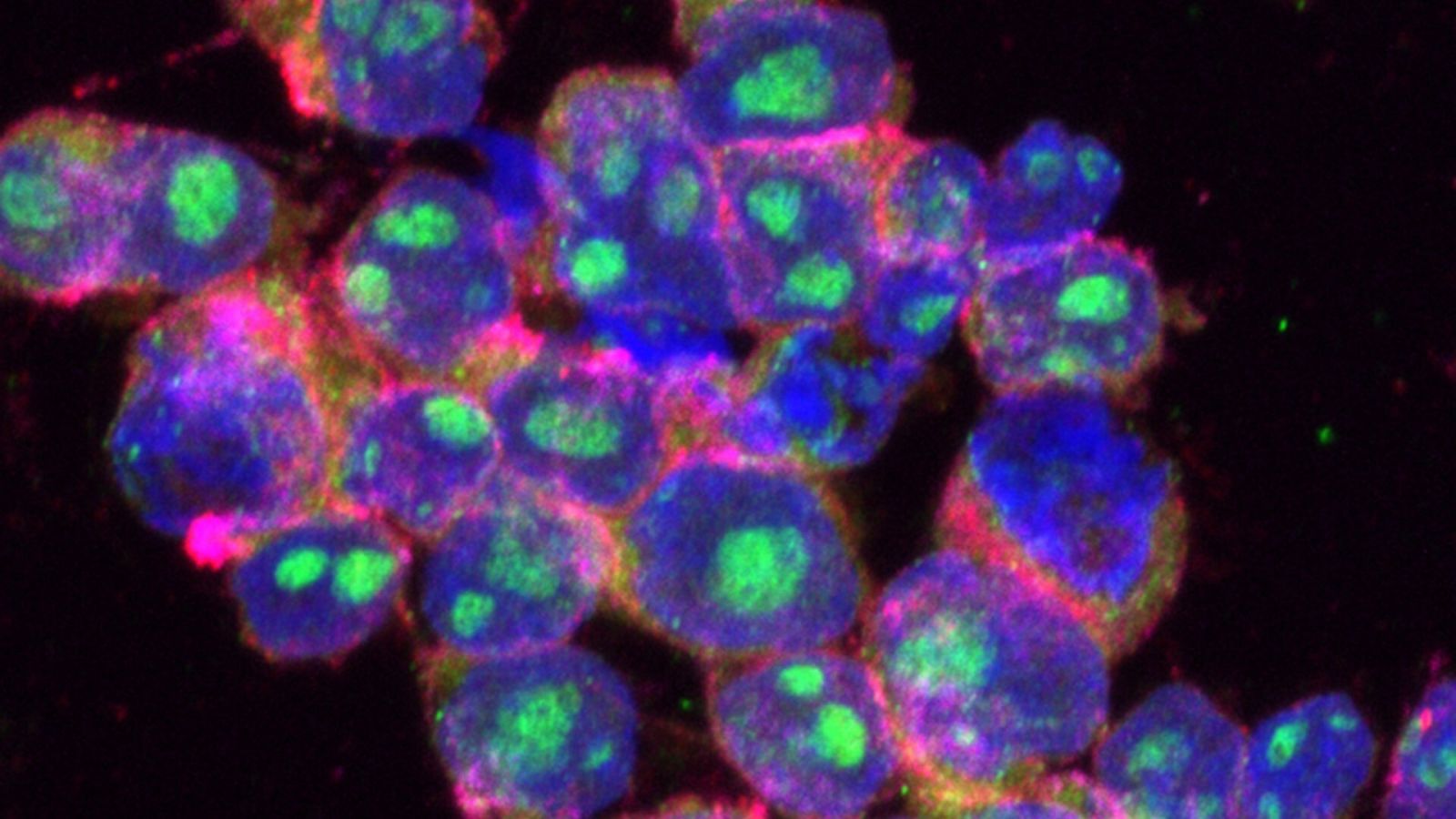 Desarrollan nanocápsulas con control remoto: células de linfoma difuso