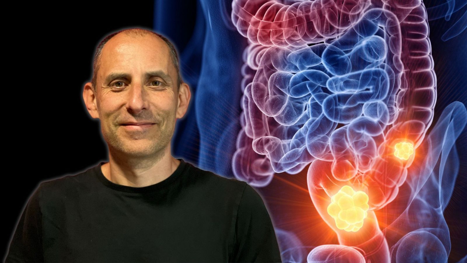 Julio Basulto analiza una información que alerta del aumento de causos de cáncer colorectal