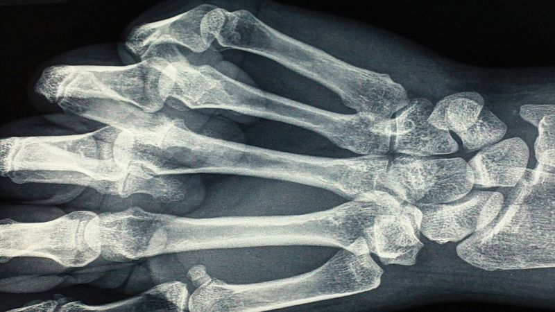 Breve historia de los rayos X, el invento que se descubri� por accidente 