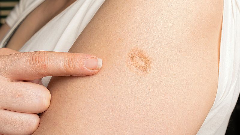 �Por qu� las personas en torno a los 40-50 a�os tienen una marca en la piel? �Desc�brelo!