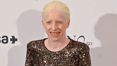 �Qu� es el albinismo?: Todo sobre esta condici�n gen�tica que no es enfermedad y no tiene cura