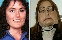 Un rosario de más de 30 operaciones para recuperar un rostro