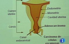 La vacuna contra el cáncer de cuello de útero es segura y eficaz en el 98% de los casos