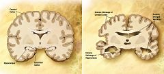 Desarrollan un método fiable con tecnología espacial para diagnosticar el alzheimer