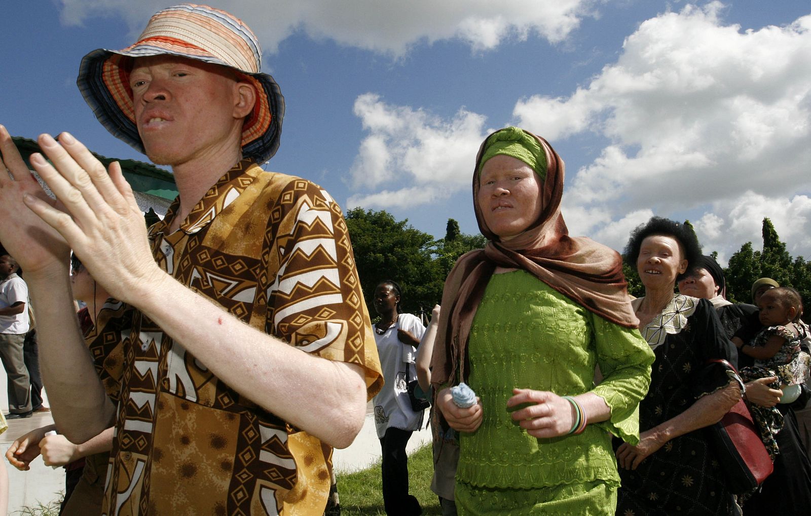 Albinos tanzanos celebran el Día de los Albinos