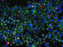 Descubren dos nuevos genes que modifican el riesgo de padecer cáncer de mama y ovario