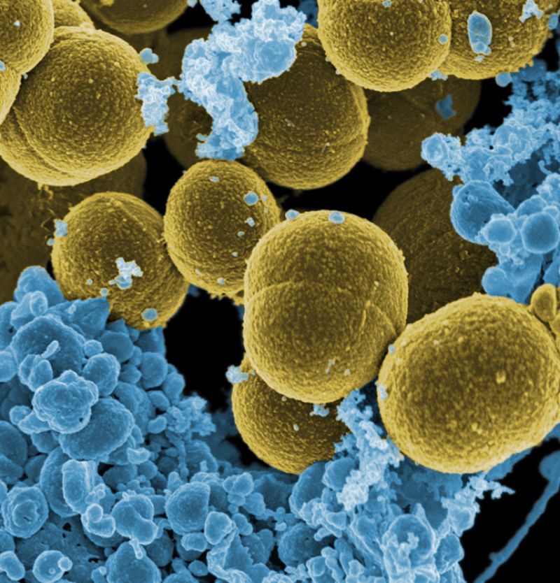 Crean un biosensor de grafeno para detectar la bacteria estafilococo dorado