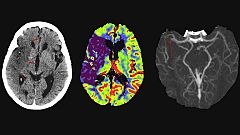 Identifican una molécula clave en el desarrollo de futuras terapias para el daño cerebral por ictus