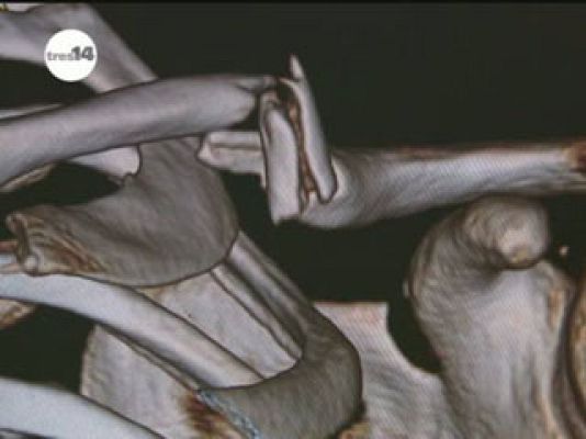  - Las fracturas más frecuentes de los pilotos