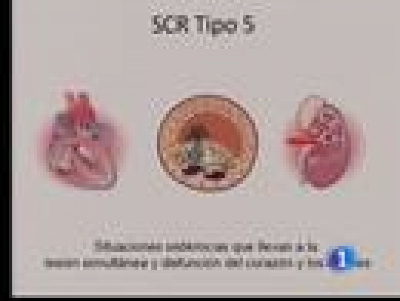 En España, 40.000 personas tienen insuficiencia renal