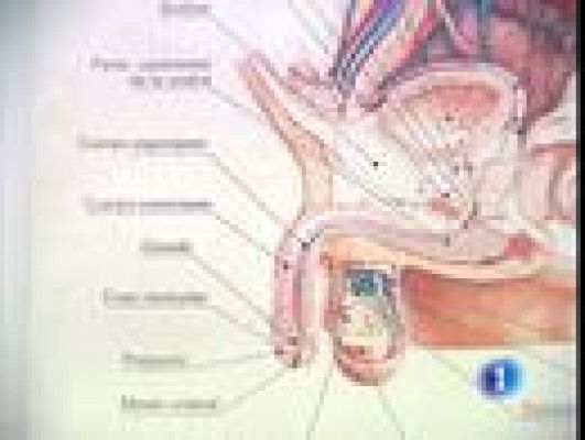 Telediario 1 - Disfunción eréctil y corazón