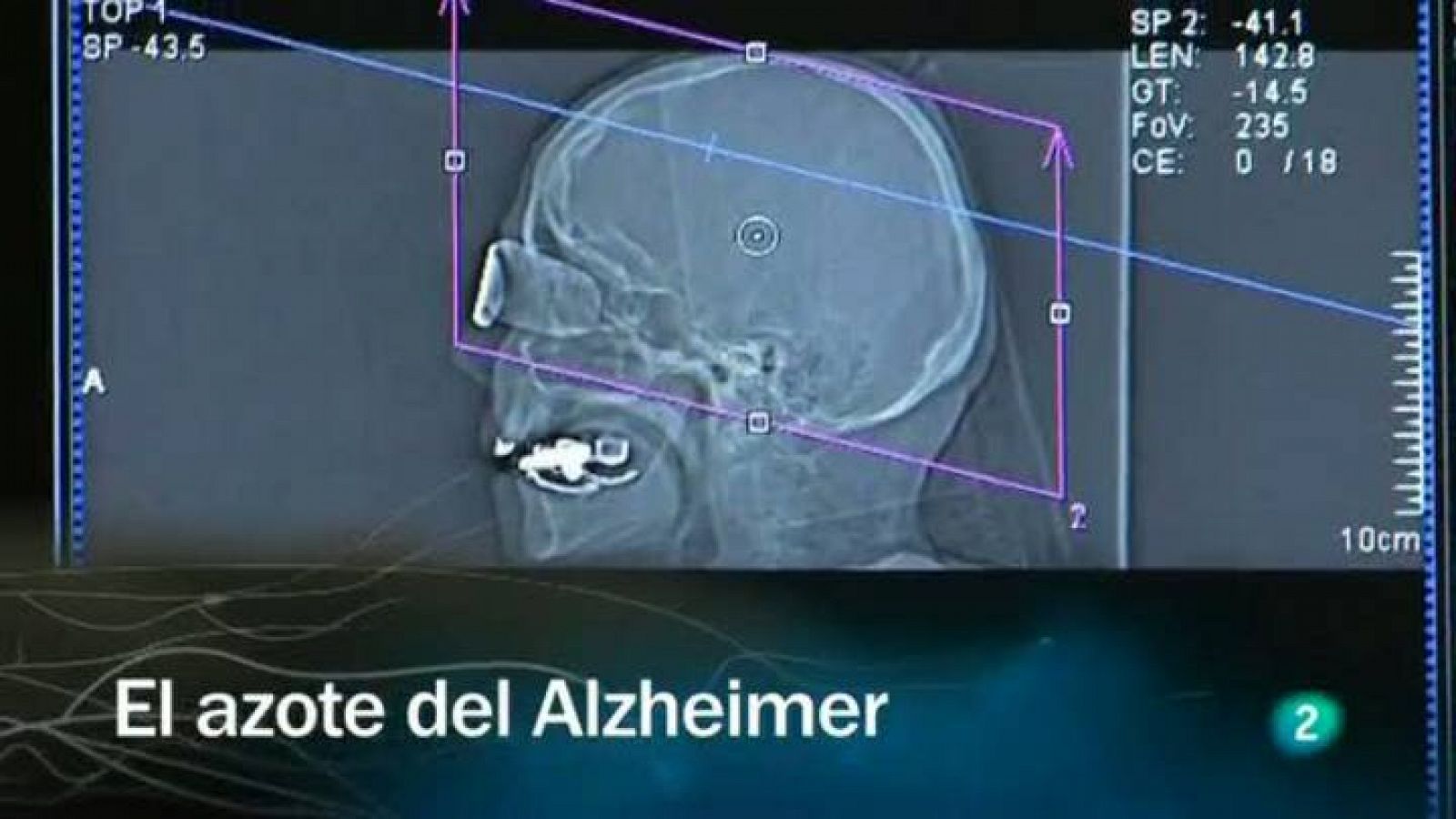 Redes - El azote del Alzheimer