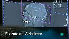 Redes - El azote del Alzheimer