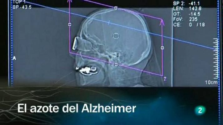 El azote del Alzheimer