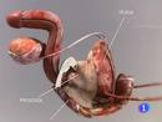 Telediario 1 - Cáncer de próstata en España