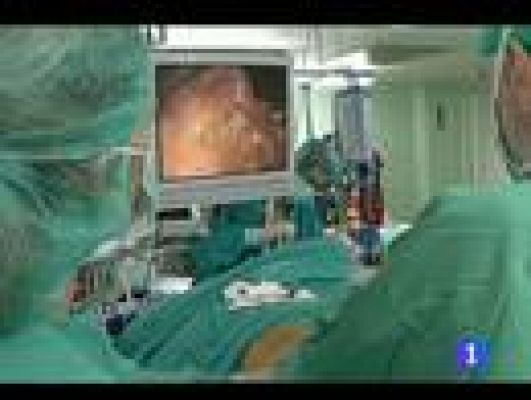 Telediario 1 - Reducción de estómago a una menor