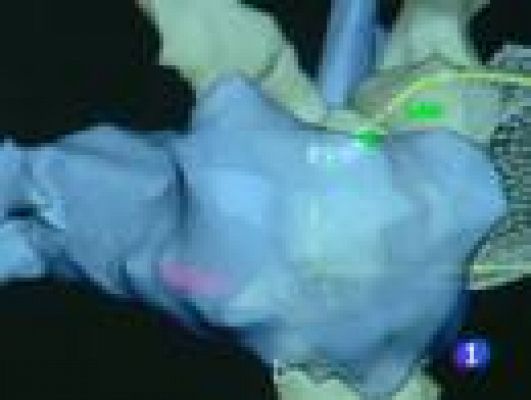 Telediario 1 - Lo último en cardiología