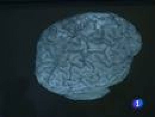 Telediario 1 - El ictus, la enfermedad desconocida