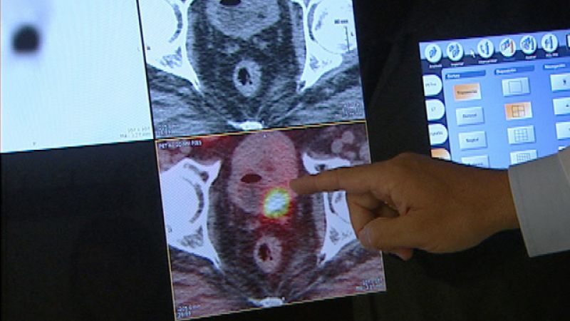 El cáncer de próstata se ha convertido en el segundo con más incidencia en el hombre 