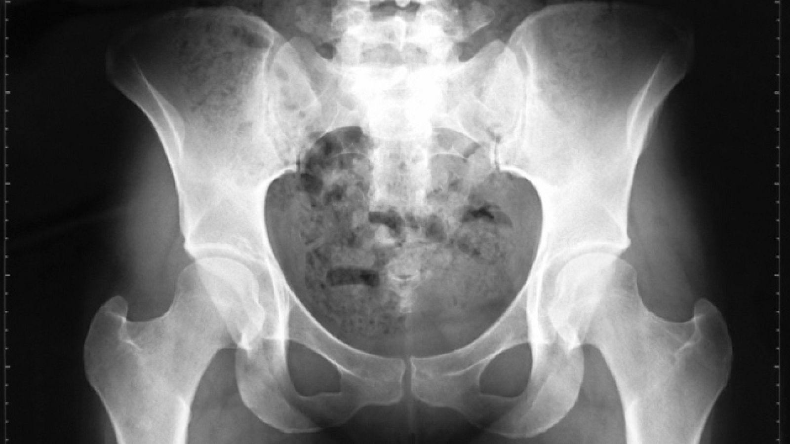 Saber vivir - Cuando los huesos se desgastan - 11/10/11