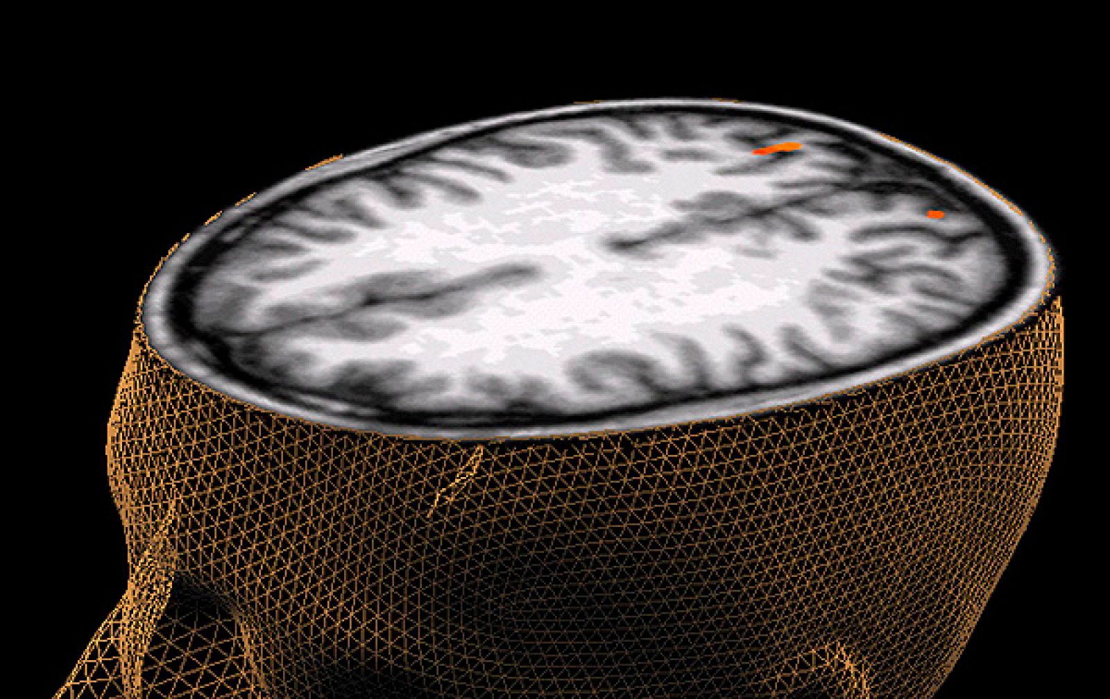 Las donaciones de cerebro, esenciales para la investigación