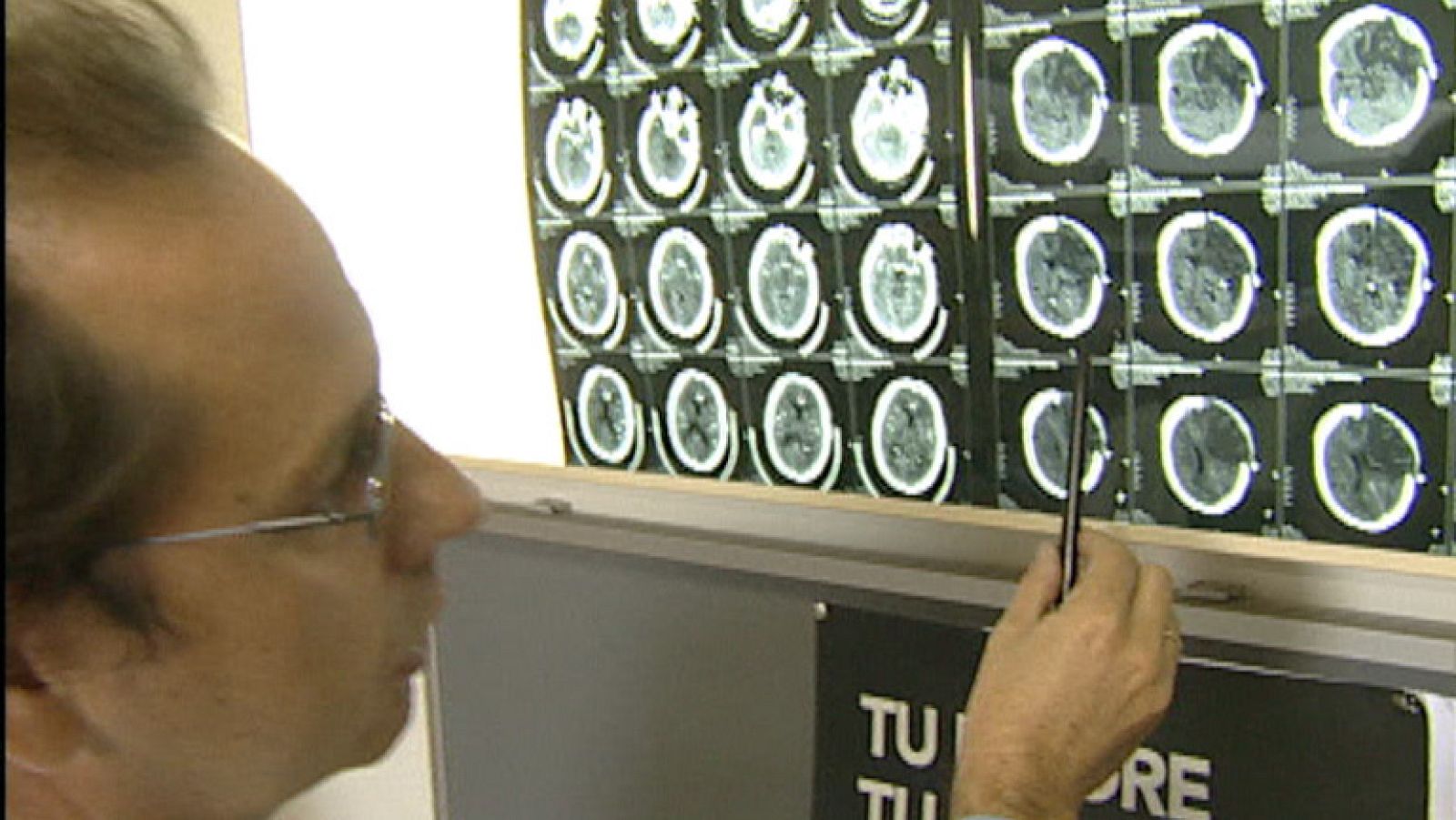 Día mundial del ictus