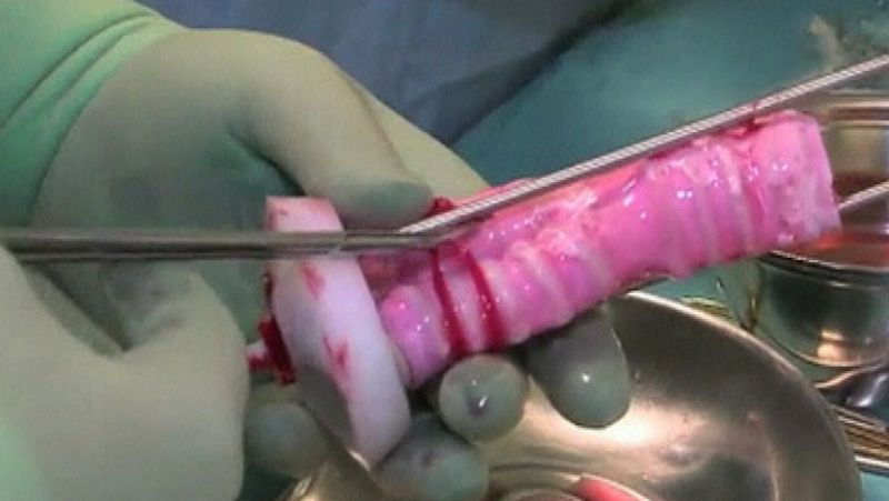 En Suecia, han creado un órgano a partir de células madre y ha sido trasplantado con éxito 