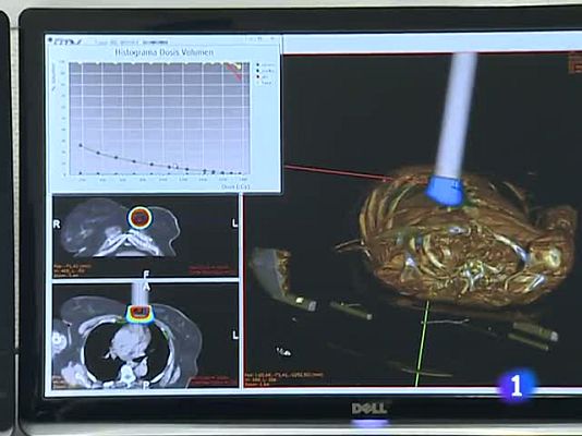 Telediario 1 - Tecnología ante el cáncer