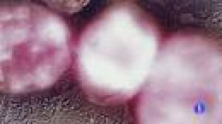 Telediario 1 - Los efectos del cáncer de colon