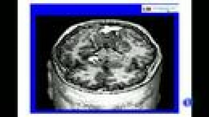 Telediario 1 - Operaciones de epilepsia