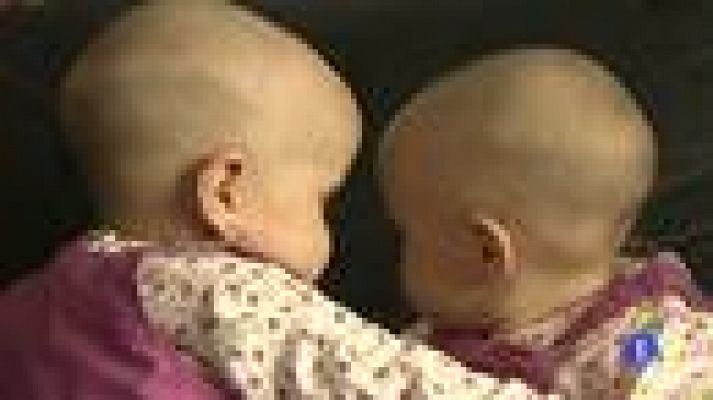 Telediario 1 - Separadas dos siamesas