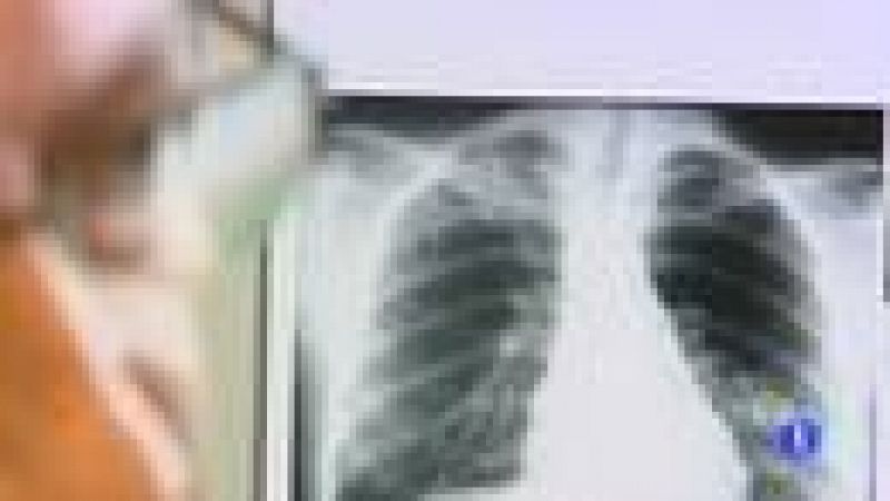 Día Mundial de la Tuberculosis, una enfermedad contagiosa por vía aérea 