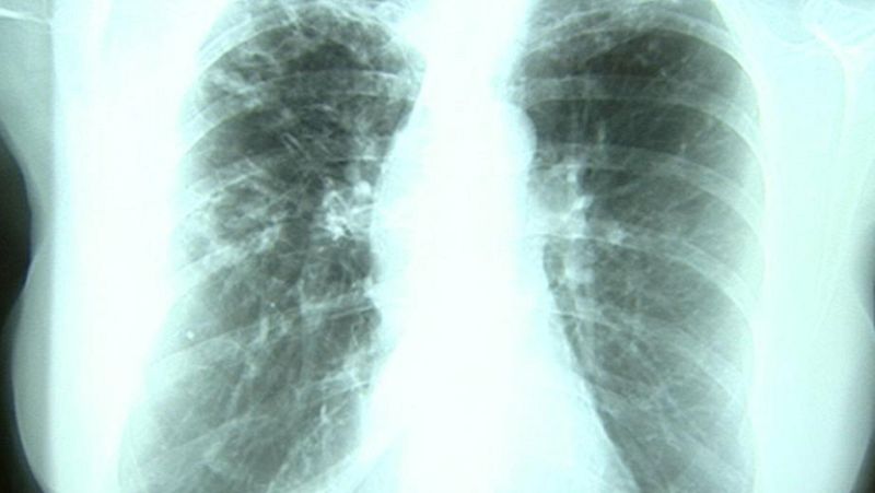 Día Mundial de la Tuberculosis, una enfermedad contagiosa por vía aérea 