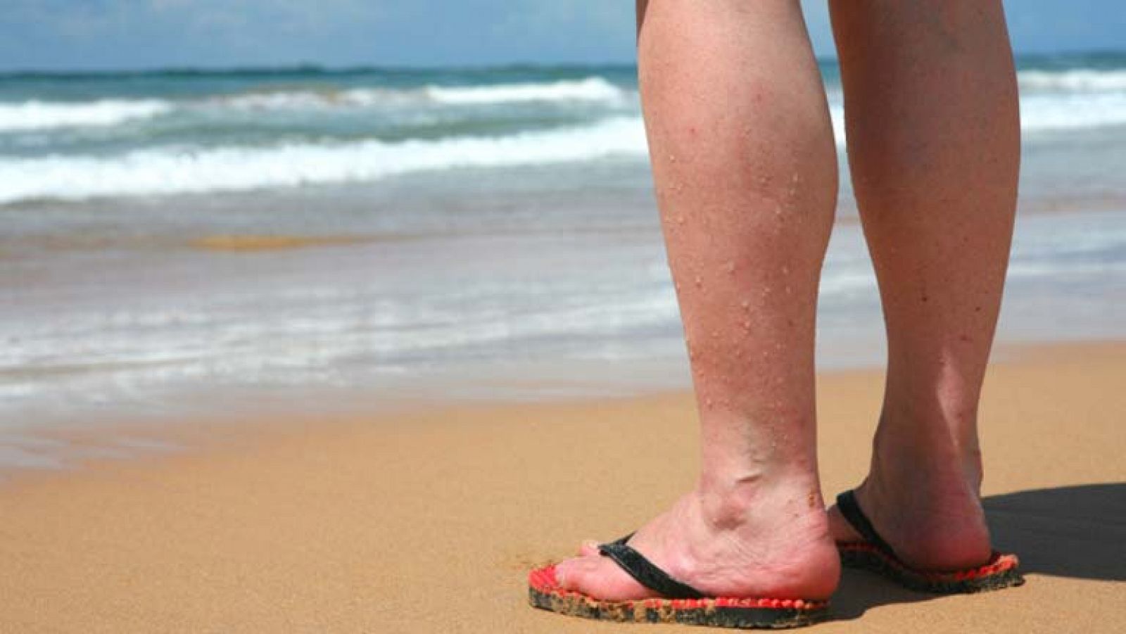 Consejos para las varices en verano - La mañana de La 1