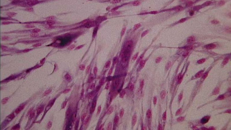 Descubren el mecanismo por el que se produce la resistencia a la quimioterapia