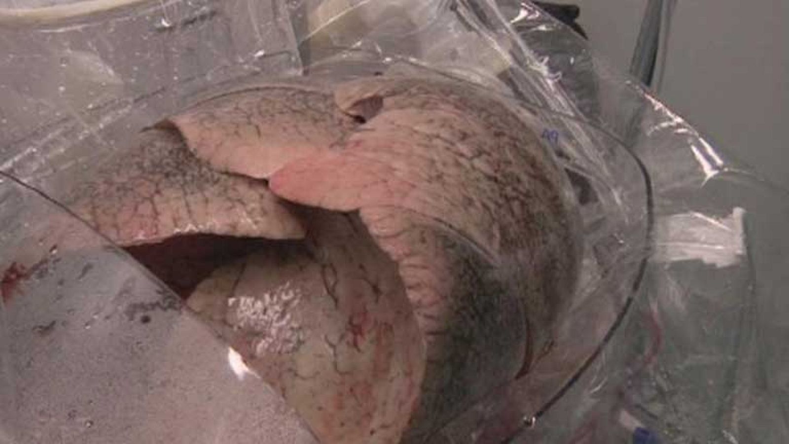 De cada cinco donaciones de pulmón sólo una es apta para trasplante