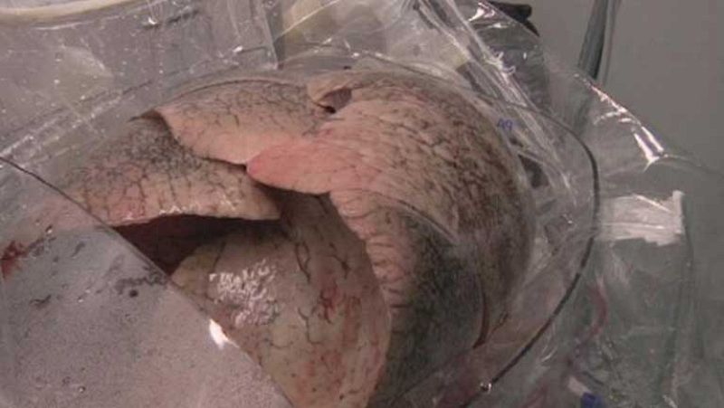 De cada cinco donaciones de pulmón sólo una es apta para trasplante