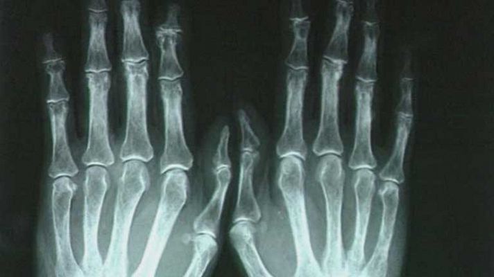 Día Mundial de la Artritis Reumatoi