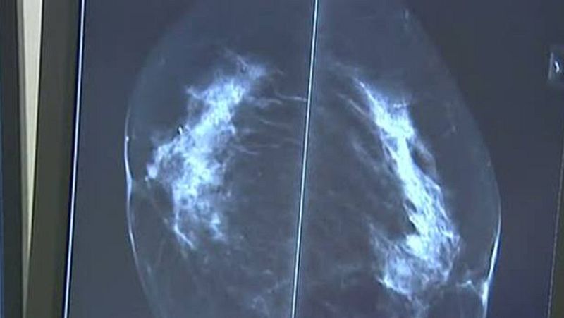 Cáncer de mama durante el embarazo, una dificultad añadida pero no fatal