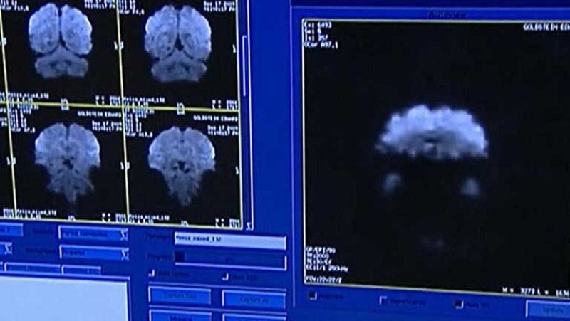 ¿Cómo descubrir los síntomas de un ictus a tiempo?