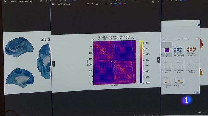 Un estudi neurocientífic permet millorar el diagnòstic i tractament de l'Alzheimer