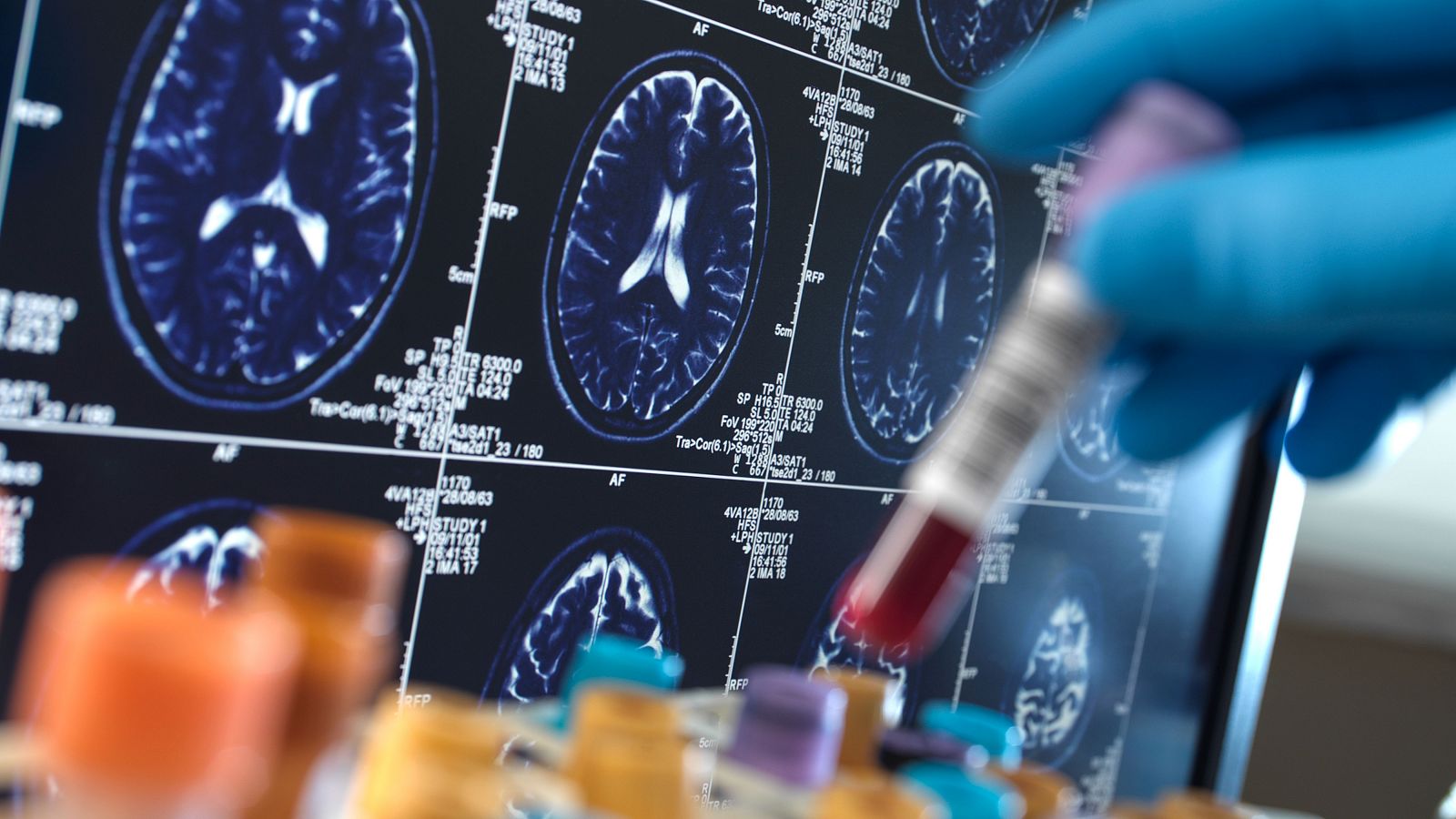 Un estudio detecta por primera vez cinco casos de alzhéimer por transmisión accidental entre humanos