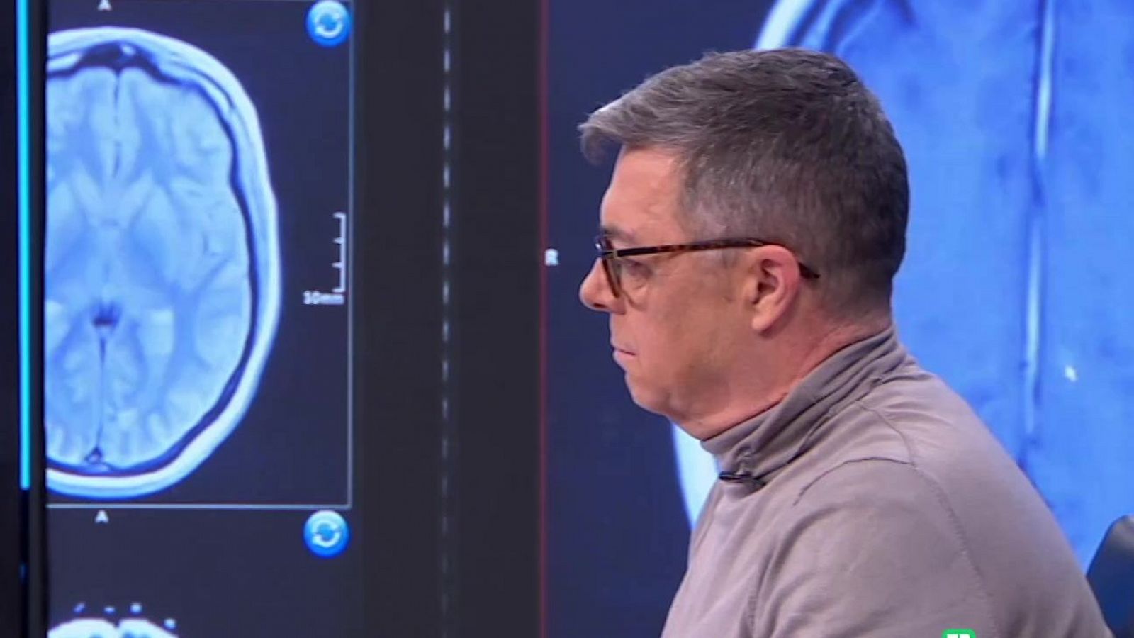 La Esclerosis Lateral Amiotrófica. ELA | Ver