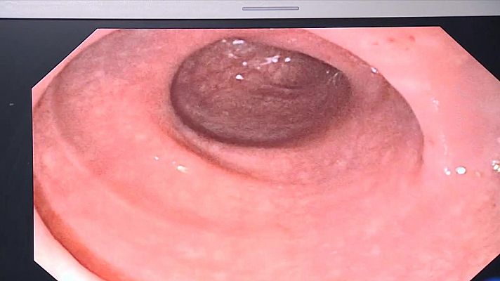 L'Informatiu - Catalunya registra 7.000 casos de càncer de còlon en el darrer any