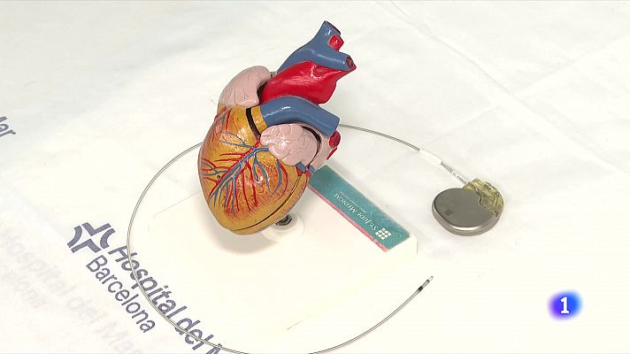 L'Informatiu - Canviar el punt d'estimulació del marcapassos dins del cor pot reduir complicacions